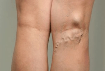 Hamile kadınlarda varisli damarların teşhisi