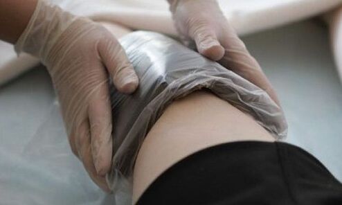 varisli damarların kompreslerle tedavisi